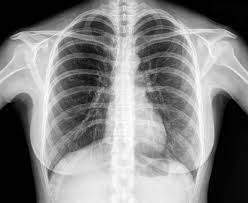 Lung X-Ray